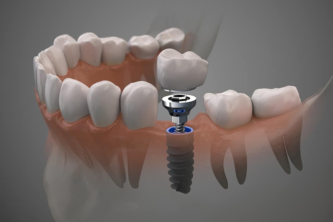 implant dentaire lyon