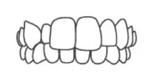 dents articulées croisées Invisalign