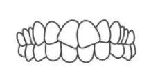 dents chevauchées Invisalign