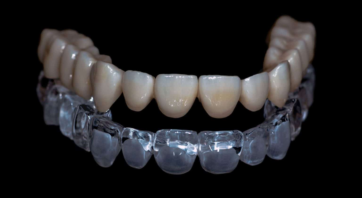 Invisalign Orthodontie par gouttière transparente | Dentiste Lyon