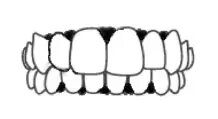 Triangles noirs Invisalign